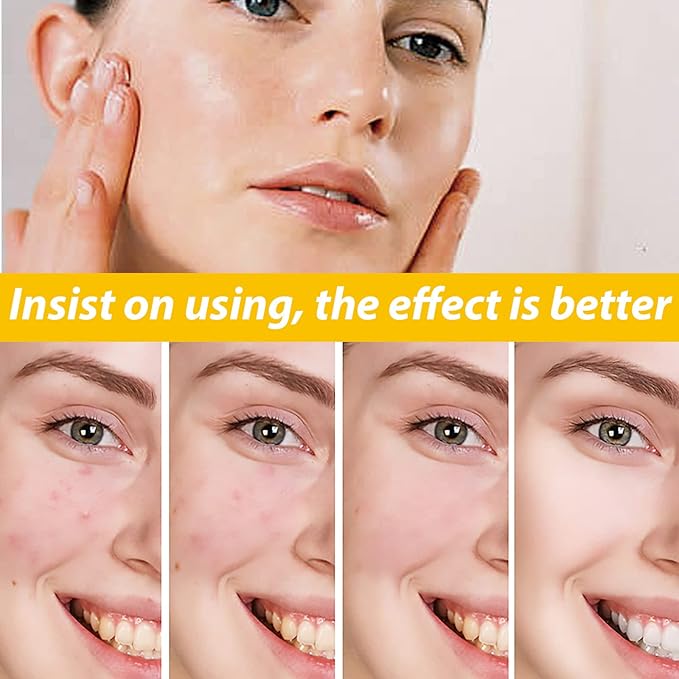 Eelhoe - Cystic Acne Cream