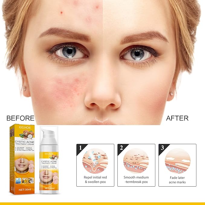 Eelhoe - Cystic Acne Cream