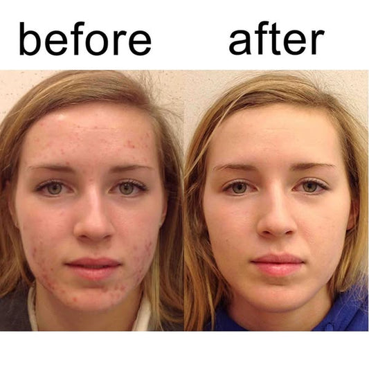 Sumifun - Expigment 4% Cream