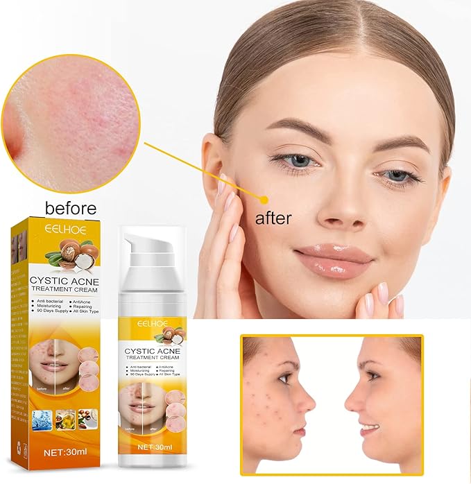 Eelhoe - Cystic Acne Cream