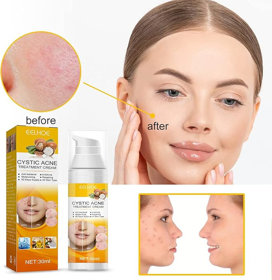 Eelhoe - Cystic Acne Cream