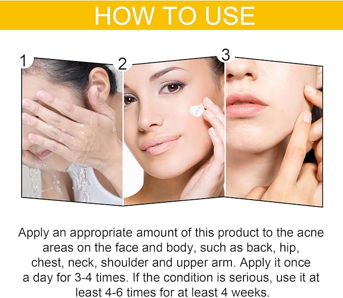 Eelhoe - Cystic Acne Cream