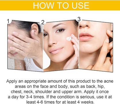 Eelhoe - Cystic Acne Cream